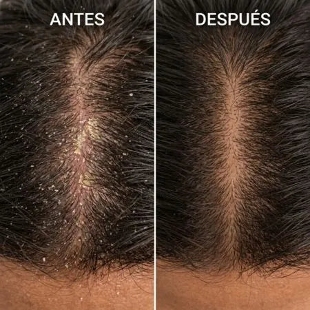 ELIMINA LA DERMATITIS DE RAÍZ