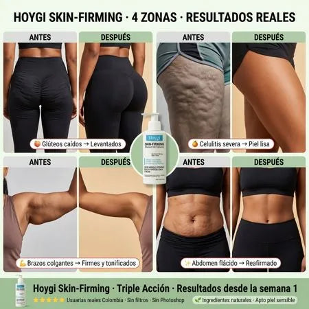 Hoygi Skin – Elimina la Celulitis y Reafirma Tu Piel
