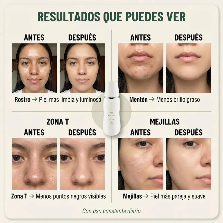 Pala Ultrasónica Facial 3 en 1 – Limpieza de Poros y Exfoliación para una Piel Suave y Fresca