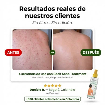Back Acne Spray — Elimina el Acné en la Espalda