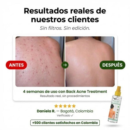 Back Acne Spray — Elimina el Acné en la Espalda
