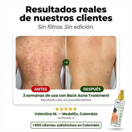Back Acne Spray — Elimina el Acné en la Espalda